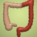 Sindrome del colon irritabile: saperne di più