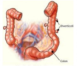 diverticolite intestinale e del sigma