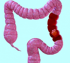 occlusione intestinale